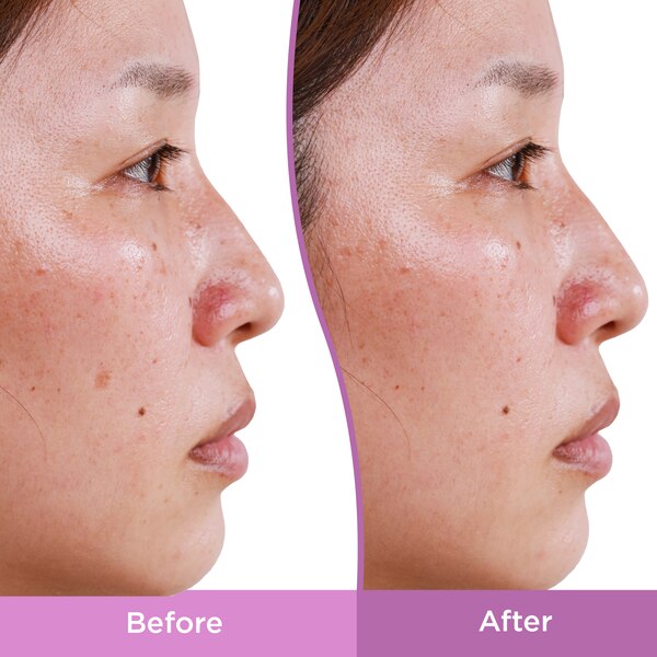 Differin Dark Spot Correcting Serum