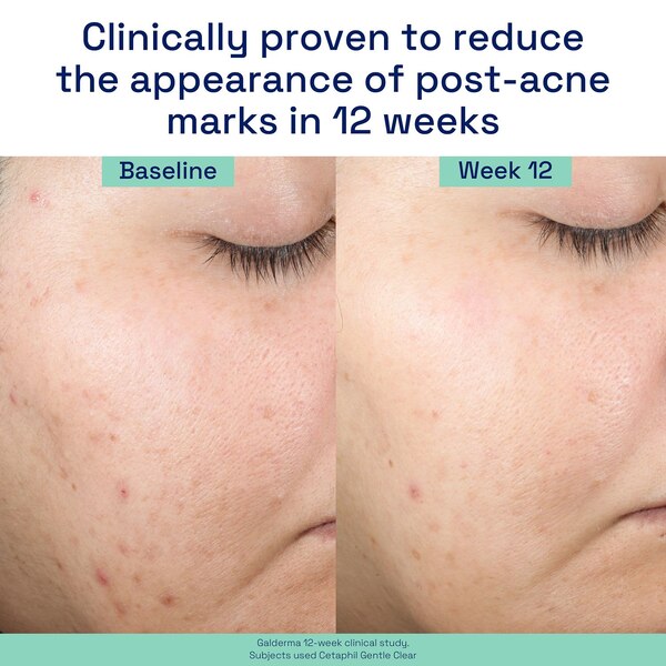 Cetaphil Acne Gentle Clear Repairing Post-Acne Serum, 0.5% Bakuchiol, 1 OZ