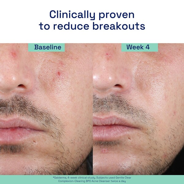 Cetaphil Gentle Clear Complexion-Clearing BPO Acne Cleanser