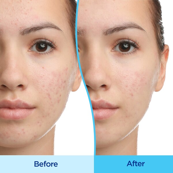 Differin Adapalene Gel 0.1% Acne Treatment, 0.5 OZ