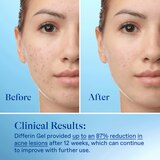 Differin .1% Adapalene Treatment 15g Pump, thumbnail image