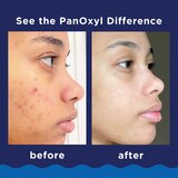 PanOxyl Foaming Wash, Maximum Strength Deep Cleaning with 10% Benzoyl Peroxide , 5.5 OZ, thumbnail image 5 of 9