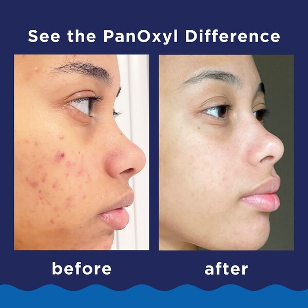 PanOxyl Foaming Wash, Maximum Strength Deep Cleaning with 10% Benzoyl Peroxide , 5.5 OZ