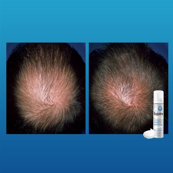 Rogaine Men's 5% Minoxidil Foam for Hair Regrowth
