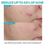 La Roche-Posay Effaclar Acne Treatment Face Serum, Salicylic Acid  Serum Treatment, 1.01 OZ, thumbnail image