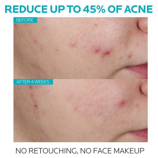 La Roche-Posay Effaclar Acne Treatment Face Serum, Salicylic Acid  Serum Treatment, 1.01 OZ