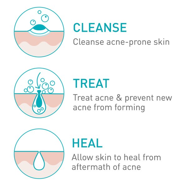 CeraVe Acne Foaming Cream Face Cleanser with 4% Benzoyl Peroxide, Hyaluronic Acid, and Niacinamide, Fragrance-Free, 5 OZ