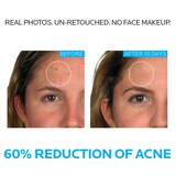 La Roche-Posay Effaclar Acne Treatment System, Salicylic Acid , Refining Toner, and Benzoyl Peroxide; for Sensitive Skin, thumbnail image