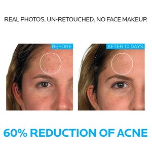 La Roche-Posay Effaclar Acne Treatment System, Salicylic Acid , Refining Toner, and Benzoyl Peroxide; for Sensitive Skin