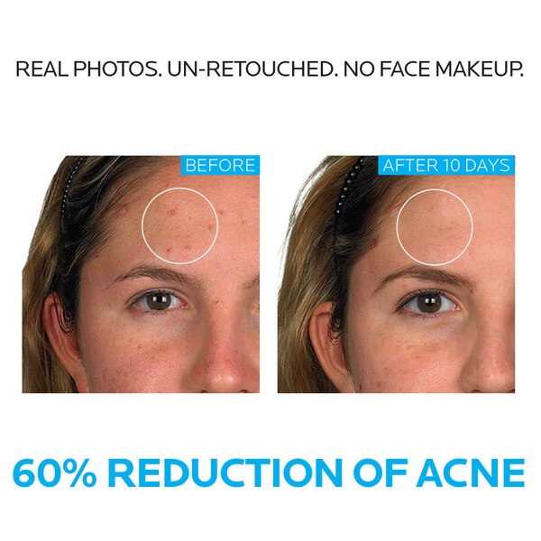 La Roche-Posay Effaclar Acne Treatment System, Salicylic Acid , Refining Toner, and Benzoyl Peroxide; for Sensitive Skin