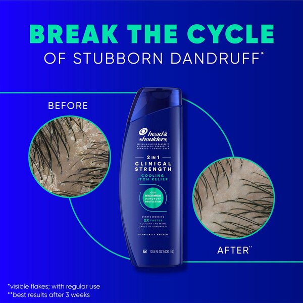 Head & Shoulders Clinical Strength Dandruff Defense Intensive Itch Relief 2-in-1 Shampoo & Conditioner, 13.5 OZ
