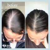 hers 2% Minoxidil Solution for Hair Regrowth, 1 Month Supply, thumbnail image