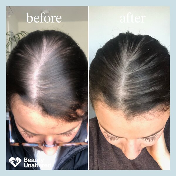 hers 2% Minoxidil Solution for Hair Regrowth, 1 Month Supply