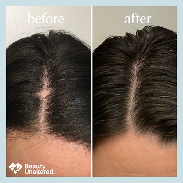 hers 2% Minoxidil Solution for Hair Regrowth, 1 Month Supply