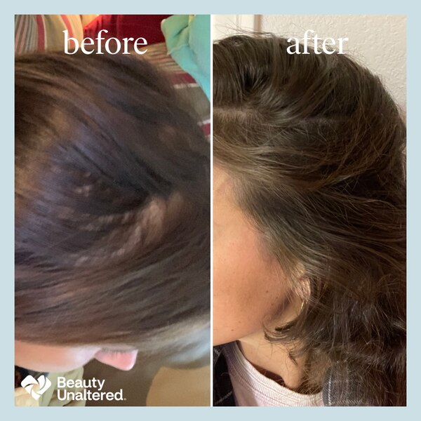 hers 2% Minoxidil Solution for Hair Regrowth, 1 Month Supply