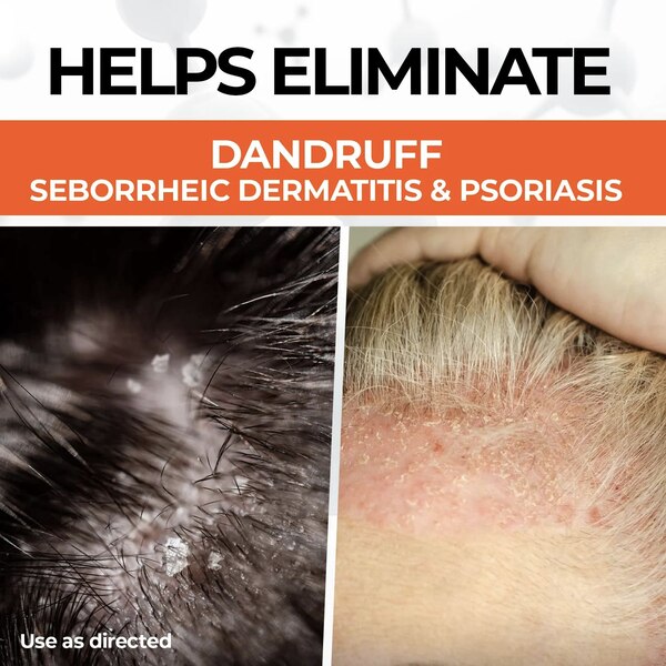 Medicasp Coal Tar Anti Dandruff Shampoo, 6 OZ
