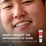 Neutrogena Rapid Clear Stubborn Acne Medicine Spot Treatment Gel, 1 OZ, thumbnail image