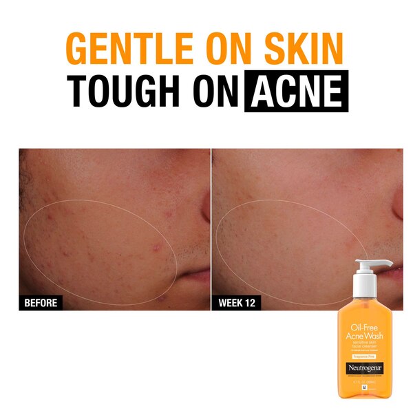 Neutrogena Oil-Free Salicylic Acid Acne Fighting Face Wash For Sensitive Skin, Fragrance-Free, 9.1 OZ