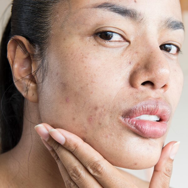 Neutrogena Stubborn Texture Acne Cleanser with Salicylic Acid
