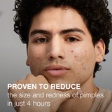 Neutrogena Stubborn Acne AM Treatment with Benzoyl Peroxide, 2 OZ, thumbnail image