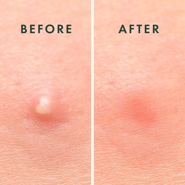 Rael Beauty Miracle Patch Overnight Spot Covers, 52 CT