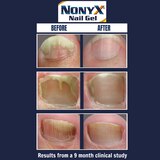 NONYX Fungal Nail Clarifying Gel, 4 OZ, thumbnail image