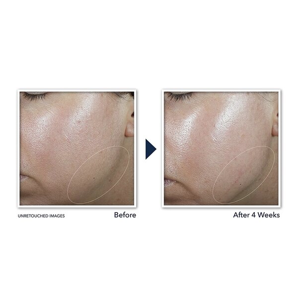 RoC Derm Correxion Contour Cream, 1.7 OZ
