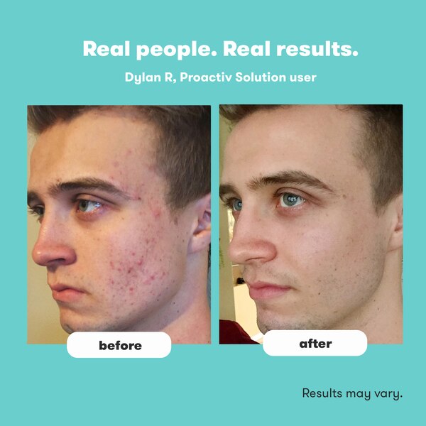 Proactiv Solution Acne Routine with Benzoyl Peroxide