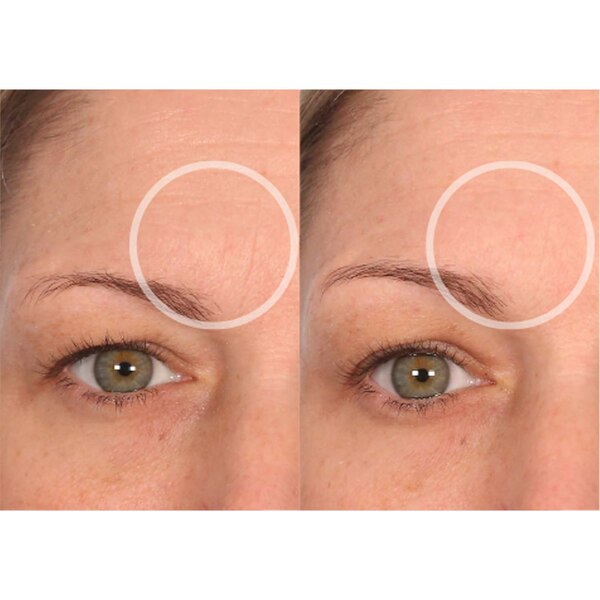SiO Mid-Brow Smoothing Wrinkle Patches, 2 CT