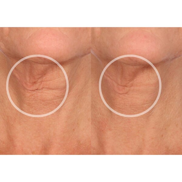 SiO Smoothing NeckLift Patch, 1 CT