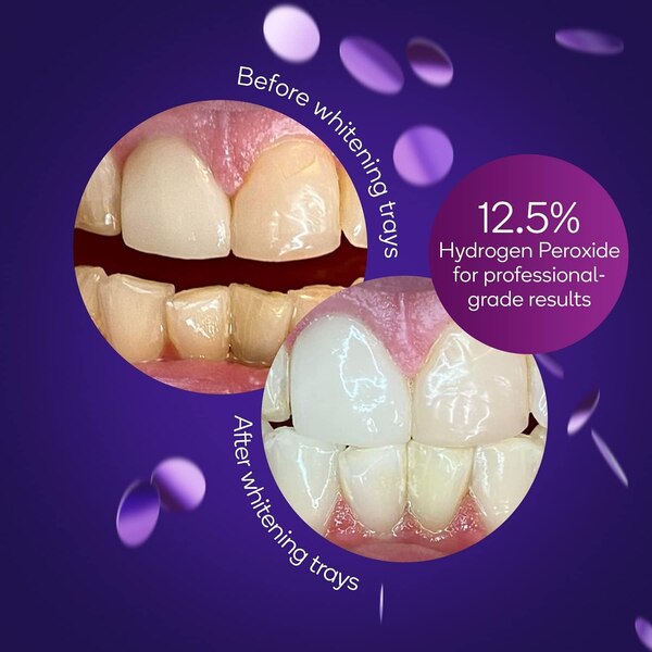 Burst Prefilled Whitening Trays, 3 Treatments