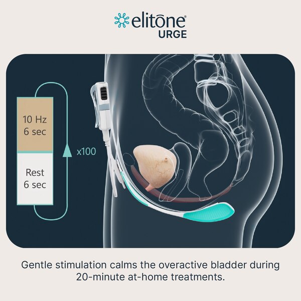 ELITONE URGE Overactive Bladder Treatment