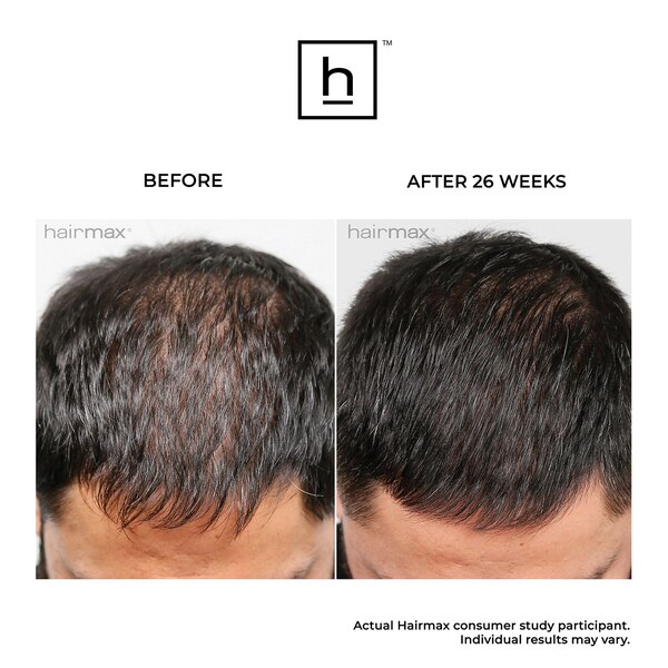 HairMax LaserBand 41 ComfortFlex Device for Hair Regrowth