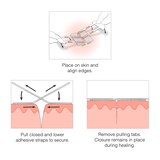 Clozex Laceration Closures, 1.5", 2 CT, thumbnail image