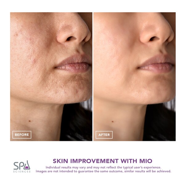 Spa Sciences MIO Diamond Microdermabrasion & Pore Extraction Skin Resurfacing System