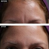 SilcSkin Facial Pads – Brow set, thumbnail image