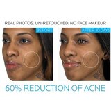 La Roche-Posay Effaclar Duo Dual Action Acne Treatment with Benzoyl Peroxide, thumbnail image 4 of 8