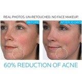 La Roche-Posay Effaclar Duo Dual Action Acne Treatment with Benzoyl Peroxide, thumbnail image 5 of 8