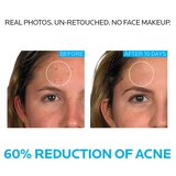 La Roche-Posay Effaclar Acne Treatment System, Salicylic Acid , Refining Toner, and Benzoyl Peroxide; for Sensitive Skin, thumbnail image 5 of 5