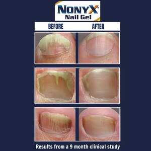 NONYX Fungal Nail Clarifying Gel, 4 OZ NONYX Fungal Nail Clarifying Gel, 4 OZ