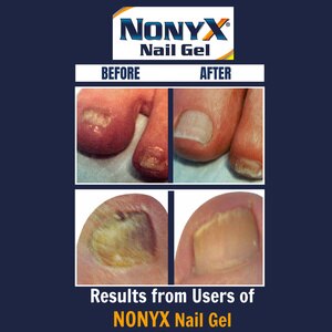 NONYX Fungal Nail Clarifying Gel, 4 OZ NONYX Fungal Nail Clarifying Gel, 4 OZ