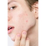 Hero Cosmetics Micropoint Acne Patch for Blemishes, thumbnail image 3 of 5