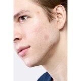 Hero Cosmetics Micropoint Acne Patch for Blemishes, thumbnail image 4 of 5