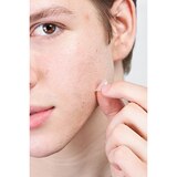 Hero Cosmetics Micropoint Acne Patch for Blemishes, thumbnail image 5 of 5