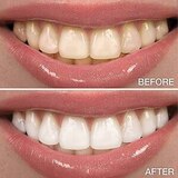 Novashine Professional Home Teeth Whitening Kit, 40+ Treatments, thumbnail image 3 of 4