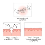Clozex Laceration Closures in Assorted Sizes, thumbnail image 4 of 5