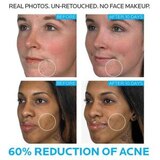 La Roche-Posay Effaclar Duo Dual Action Acne Treatment with Benzoyl Peroxide, thumbnail image 4 of 9