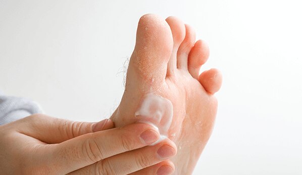 Athlete s Foot Treatment Symptoms MinuteClinic